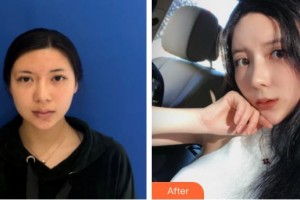 廊坊凱潤婷（原悅美）醫(yī)療美容門診部郭佳穎整形價格表附熱瑪吉案例展示