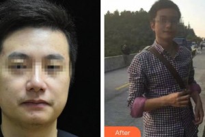 廊坊東方美容整形醫(yī)院孟亞秀整形價格表附熱拉提案例展示