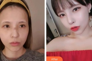 廊坊凱潤婷（原悅美）醫(yī)療美容門診部鄭浩朱整形價格表附熱拉提案例展示