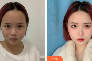 衡水天宏醫(yī)療美容醫(yī)院楊紅曉整形價(jià)格表附激光祛斑案例展示