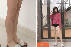 衡水瑞美醫(yī)療美容門(mén)診部杜軼男整形價(jià)格表附激光祛疤案例展示