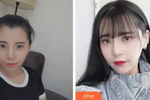 衡水愛(ài)爾眼科醫(yī)院陳麗萍整形價(jià)格表附眼部綜合案例展示