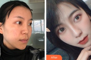 哈爾濱索菲整形美容醫(yī)院陳富全整形價格表附隆鼻手術(shù)案例展示