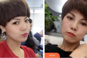 衡水愛爾眼科醫(yī)院王慈整形價格表附埋線雙眼皮案例展示