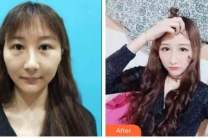 衡水愛(ài)爾眼科醫(yī)院翟密整形價(jià)格表附開(kāi)內(nèi)眼角案例展示