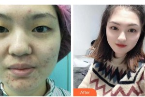 衡水愛(ài)爾眼科醫(yī)院彭永奎整形價(jià)格表附眼部綜合案例展示