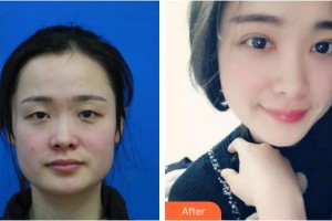 衡水愛(ài)爾眼科醫(yī)院胡連潤(rùn)整形價(jià)格表附眼部綜合案例展示