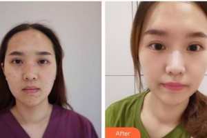 山西省整形外科醫(yī)院劉晉元整形價格表附激光點痣案例展示