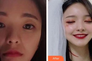 山西伊特雅整形美容門診部張輝整形價格表附去痘印痘坑例展示