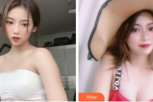 山西武警總醫(yī)院醫(yī)學(xué)整形美容中心徐保境整形價格表附自體脂肪隆胸案例展示