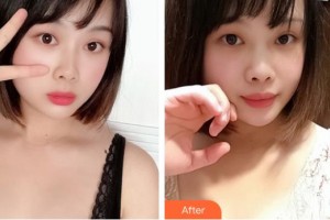 山西陽泉友愛醫(yī)院醫(yī)學(xué)美容科郭慶福整形價格表附自體脂肪隆胸案例展示