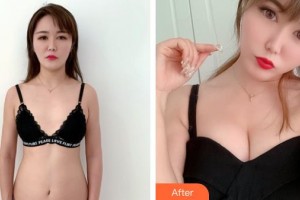 山西伊特雅整形美容門診部王鳳芹整形價格表附自體脂肪隆胸案例展示