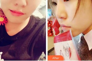 山西醫(yī)科大學(xué)附屬太鋼總醫(yī)院燒傷整形中心郝振明整形價格表附光子嫩膚案例展示