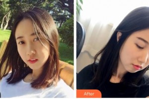 山西醫(yī)科大學(xué)附屬太鋼總醫(yī)院燒傷整形中心趙志偉整形價格表附彩光嫩膚案例展示