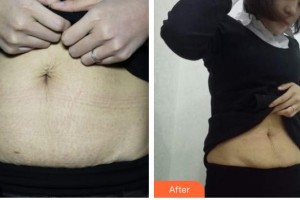 山西立仁激光整形醫(yī)院韓宏芳整形價(jià)格表附祛妊娠紋案例展示