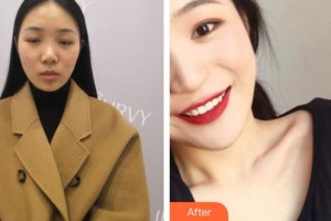 山西省整形外科醫(yī)院孟慶璋整形價格表附清潔祛痘案例展示