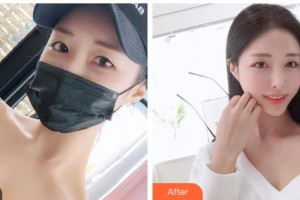 山西現(xiàn)代婦產(chǎn)醫(yī)院整形美容中心趙建華整形價格表附去痘印痘坑案例展示