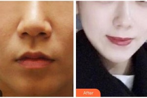 山西省整形外科醫(yī)院陳齊鳴整形價格表附微針美膚案例展示