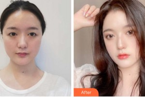 蘭州中泰整形美容醫(yī)院裴彥鵬整形價(jià)格表附眼部手術(shù)案例展示