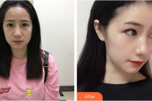 蘭州韓美整形美容醫(yī)院吳珉整形價(jià)格表附植發(fā)案例展示