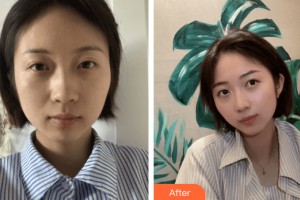 蘭州愛(ài)美相伴醫(yī)療美容門診部張莉整形價(jià)格表附皮膚美容案例展示