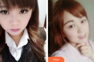 蘭州明倫醫(yī)療美容門診部張磊整形價(jià)格表附牙齒矯正案例展示