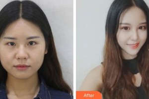 山西省眼科醫(yī)院常敏整形價(jià)格表附切開雙眼皮案例展示