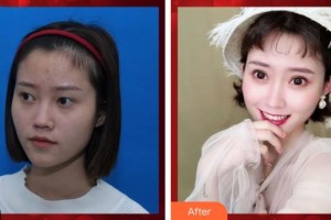 山西省眼科醫(yī)院湯兆強(qiáng)整形價(jià)格表附切開雙眼皮案例展示