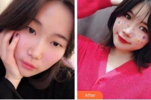 山西省眼科醫(yī)院申長(zhǎng)禮整形價(jià)格表附切開雙眼皮案例展示