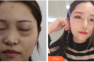 山西省眼科醫(yī)院吳艷整形價(jià)格表附激光去眼袋案例展示