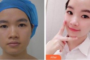 山西省眼科醫(yī)院曲建梅整形價(jià)格表附切眉術(shù)案例展示