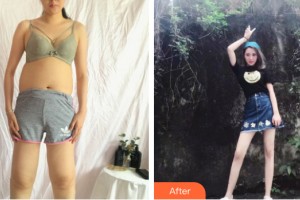 蘭州夢怡美醫(yī)療美容門診李雪清整形價格表附大腿吸脂案例展示