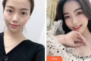 山西省眼科醫(yī)院曹偉芳整形價(jià)格表附切開雙眼皮案例展示