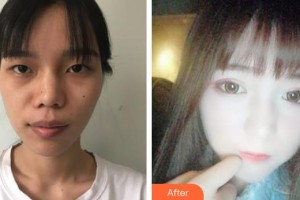 山西省眼科醫(yī)院王瑞姝整形價格表附眼部綜合案例展示