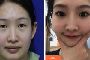 山西省眼科醫(yī)院柴飛燕整形價格表附眼部綜合案例展示