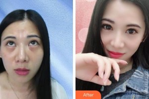 山西省眼科醫(yī)院劉文潔整形價格表附激光去眼袋案例展示