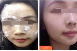 太原解放軍264醫(yī)院美容整形中心劉勁燕整形價格表附祛斑祛痣案例展示