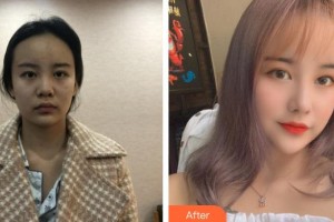 太原華美整形美容醫(yī)院李國玲整形價格表附鼻部綜合案例展示