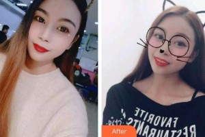 太原麗都整形美容醫(yī)院楊東育整形價格表附金屬托槽矯正案例展示