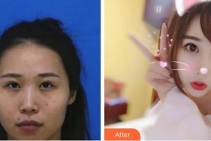 太原麗都整形美容醫(yī)院張桂英整形價格表附去痘印痘坑案例展示