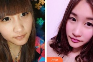 太原歐美蓮整形美容醫(yī)院白勝旭整形價格表附鼻部綜合案例展示