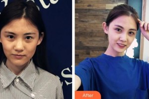 太原市第二人民醫(yī)院整形美容科李明森整形價(jià)格表附鼻部綜合案例展示