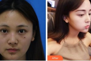 太原青松醫(yī)療美容門診部金漢祚整形價(jià)格表附硅膠隆鼻案例展示