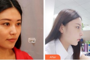 太原星范醫(yī)療美容門診部陳德裕整形價(jià)格表附鼻部綜合案例展示