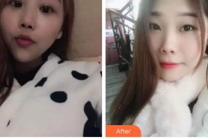 太原美萊整形醫(yī)院高娟整形價(jià)格表附熱拉提案例展示