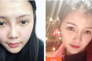 太原塑美美容整形門診部樊婭娜整形價(jià)格表附鼻部綜合案例展示