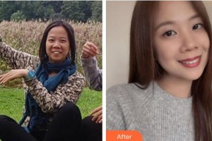 太原時光整形美容醫(yī)院白麗鵬整形價格表附金屬托槽矯正案例展示