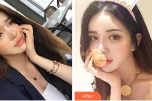 太原時光整形美容醫(yī)院趙志榮整形價格表附清潔祛痘案例展示