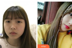 太原時光整形美容醫(yī)院張俊整形價格表附光子嫩膚案例展示