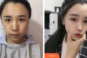 太原晉容整形美容門診部王亞琪整形價格表附超聲提拉案例展示